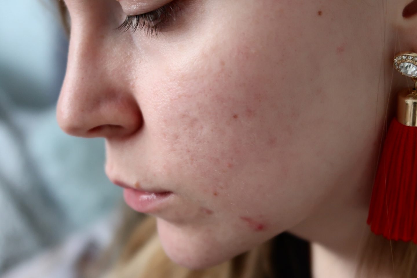 My 2 Years Post Acne Skin | Thoughts & Reflections